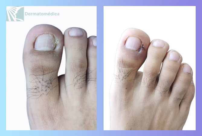 Cicatriz queloide preauricular