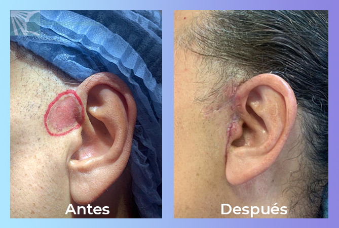 Cicatriz Acne y Tratamiento Laser