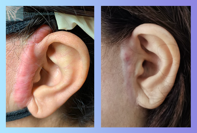 Cicatriz queloide preauricular
