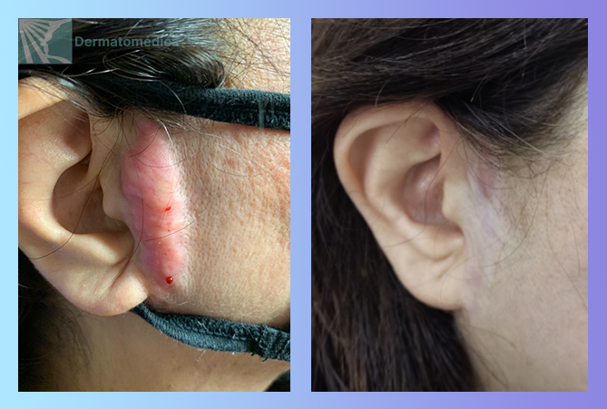 Cicatriz queloide preauricular