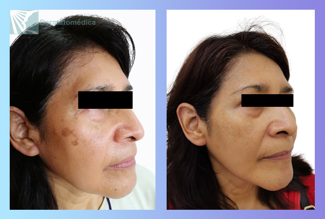 Paciente con lentigo solar