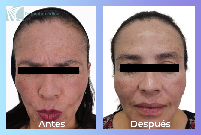 Paciente antes de aplicación de toxina botulinica