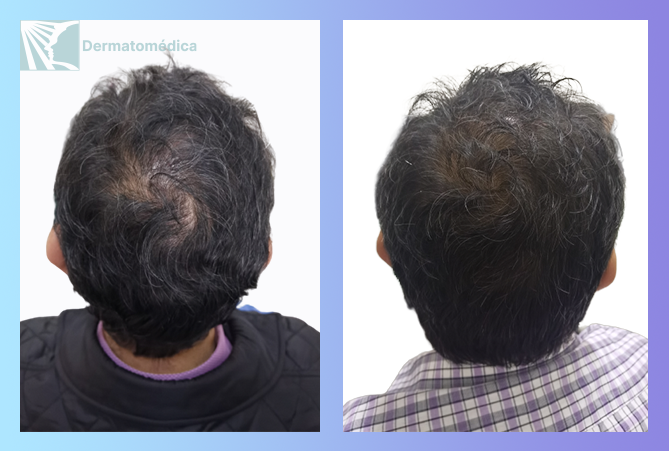 Cicatriz queloide preauricular